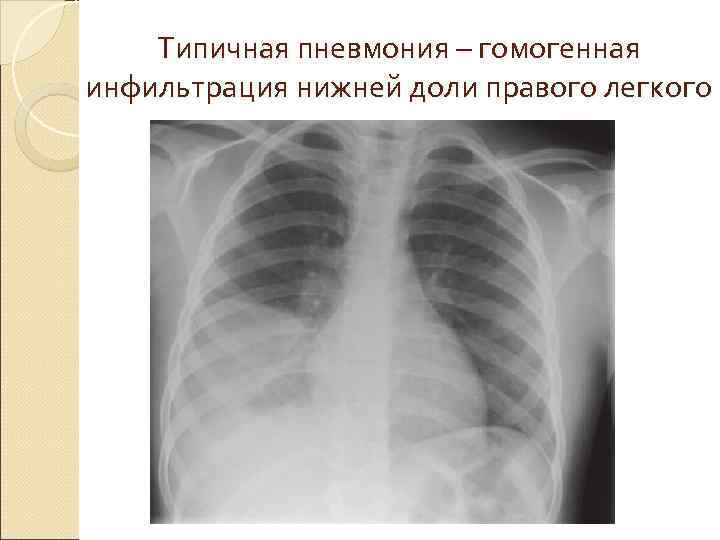 Образование в нижней доле легкого