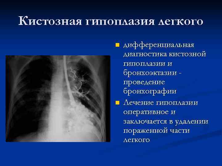 Гипоплазия легкого фото