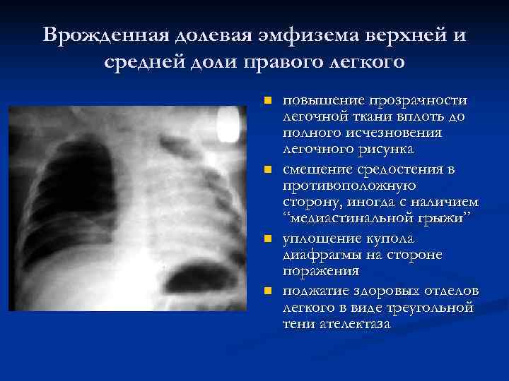 Пороки развития легких презентация