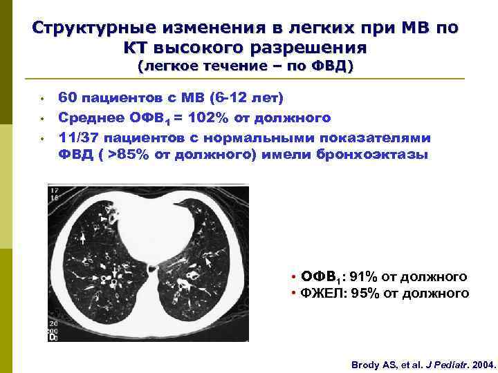 Структурные изменения в легких при МВ по   КТ высокого разрешения  