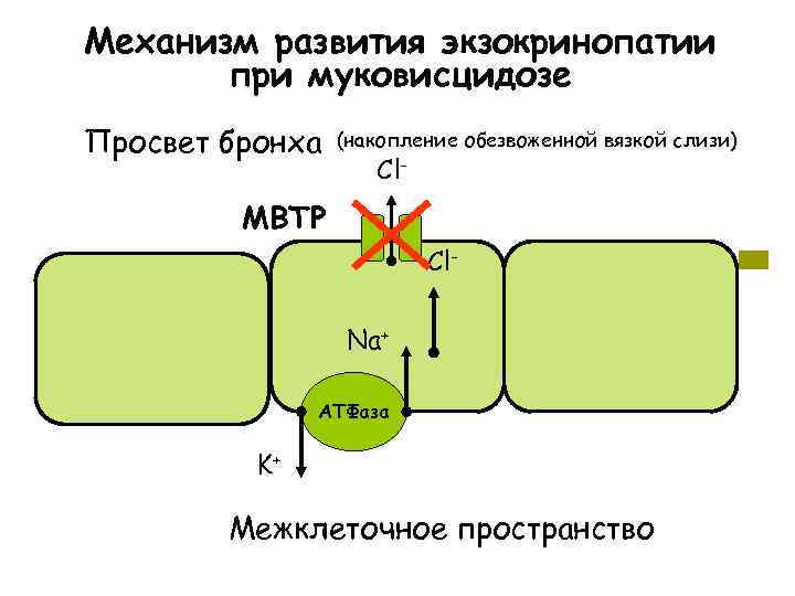 Механизм развития экзокринопатии  при муковисцидозе Просвет бронха  (накопление обезвоженной вязкой слизи) 