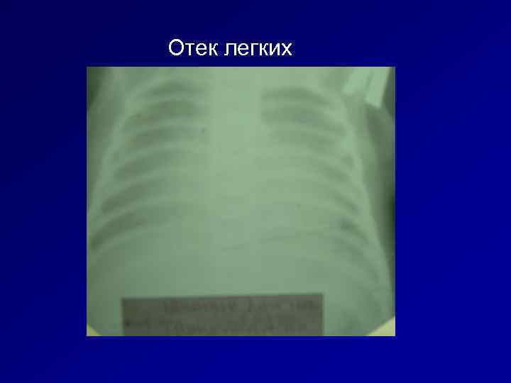 Отек легких 