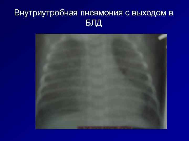Внутриутробная пневмония с выходом в   БЛД 