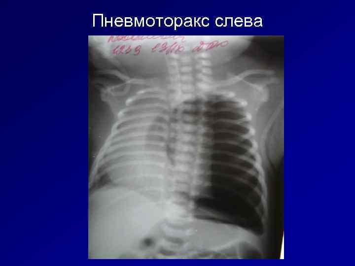 Пневмоторакс слева 