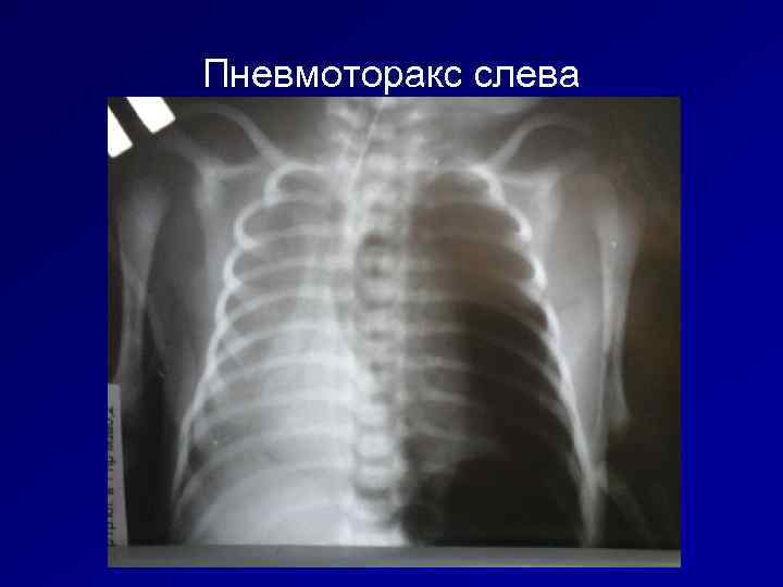 Пневмоторакс слева 