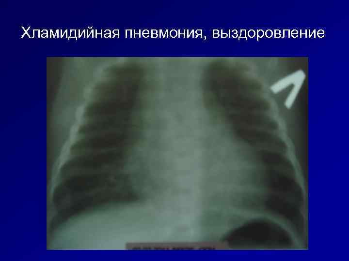 Хламидийная пневмония, выздоровление 