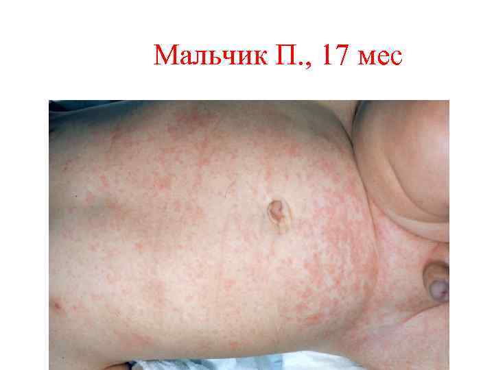 Мальчик П. , 17 мес 