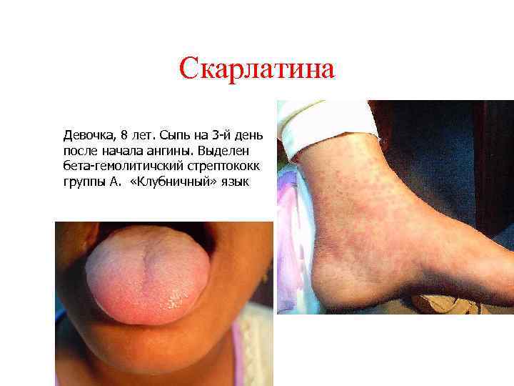 Скарлатина Девочка, 8 лет. Сыпь на 3 -й день после начала ангины. Выделен бета-гемолитичский