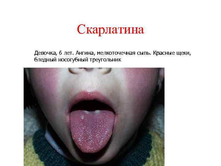 Скарлатина Девочка, 6 лет. Ангина, мелкоточечная сыпь. Красные щеки, бледный носогубный треугольник 