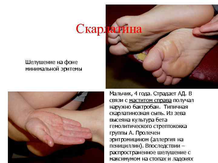 Скарлатина Шелушение на фоне минимальной эритемы Мальчик, 4 года. Страдает АД. В связи с
