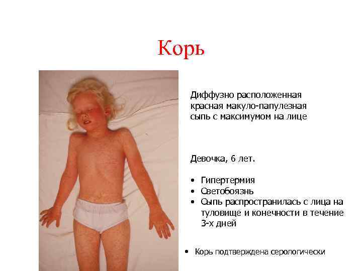 Корь Диффузно расположенная красная макуло-папулезная сыпь с максимумом на лице Девочка, 6 лет. •