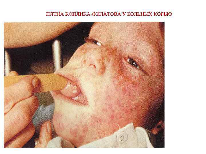 ПЯТНА КОПЛИКА-ФИЛАТОВА У БОЛЬНЫХ КОРЬЮ 