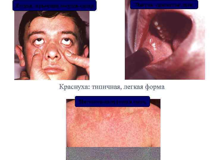 Легкая инъекция сосудов склер Чистая слизистая щек Краснуха: типичная, легкая форма Пятнисто-папулезная сыпь 