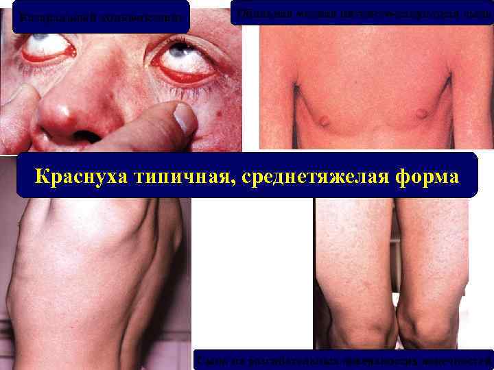 Катаральный конъюнктивит Обильная мелкая пятнисто-папулезная сыпь Краснуха типичная, среднетяжелая форма Сыпь на разгибательных поверхностях