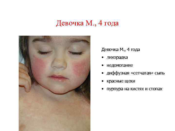 Девочка М. , 4 года • лихорадка • недомогание • диффузная «сетчатая» сыпь •