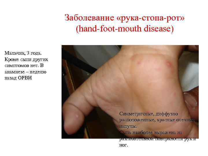 Заболевание «рука-стопа-рот» (hand-foot-mouth disease) Мальчик, 3 года. Кроме сыпи других симптомов нет. В анамнезе