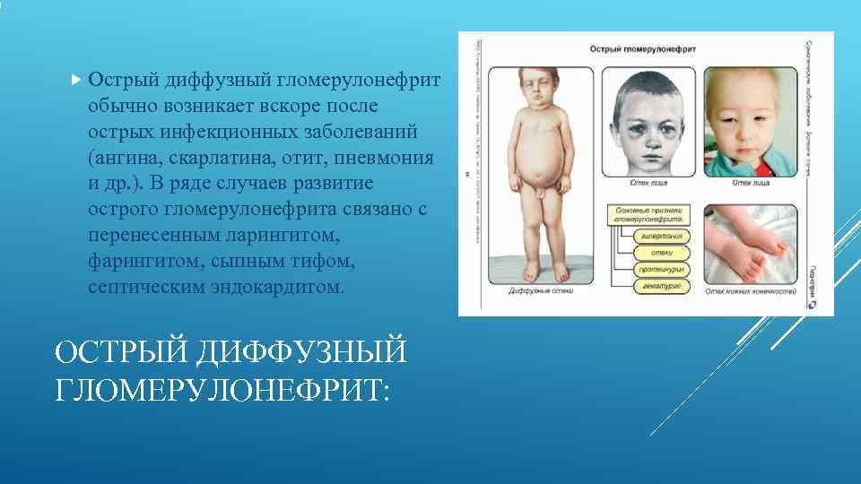  Острый диффузный гломерулонефрит обычно возникает вскоре после острых инфекционных заболеваний (ангина, скарлатина, отит,