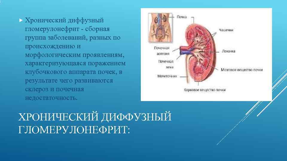  Хронический диффузный гломерулонефрит - сборная группа заболеваний, разных по происхождению и морфологическим проявлениям,