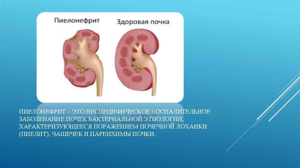 ПИЕЛОНЕФРИТ – ЭТО НЕСПЕЦИФИЧЕСКОЕ ВОСПАЛИТЕЛЬНОЕ ЗАБОЛЕВАНИЕ ПОЧЕК БАКТЕРИАЛЬНОЙ ЭТИОЛОГИИ, ХАРАКТЕРИЗУЮЩЕЕСЯ ПОРАЖЕНИЕМ ПОЧЕЧНОЙ ЛОХАНКИ (ПИЕЛИТ),