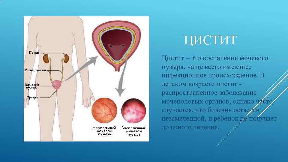  ЦИСТИТ Цистит – это воспаление мочевого пузыря, чаще всего имеющее инфекционное происхождение. В