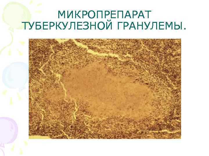МИКРОПРЕПАРАТ ТУБЕРКУЛЕЗНОЙ ГРАНУЛЕМЫ. МИКРОПРЕПАРАТ ТУБЕРКУЛЕЗНОЙ ГРАНУЛЕМЫ.