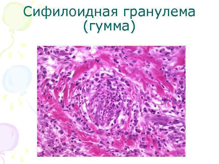 Сифилоидная гранулема (гумма) Сифилоидная гранулема (гумма)