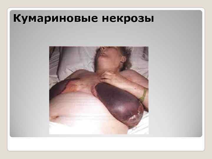 Кумариновые некрозы Кумариновые некрозы