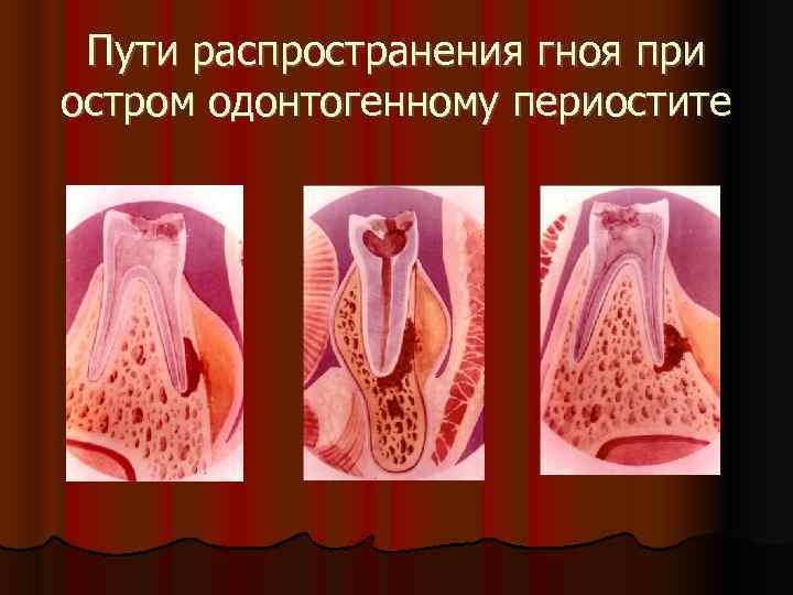  Пути распространения гноя при остром одонтогенному периостите 