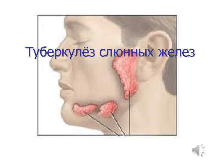 Туберкулёз слюнных желез 
