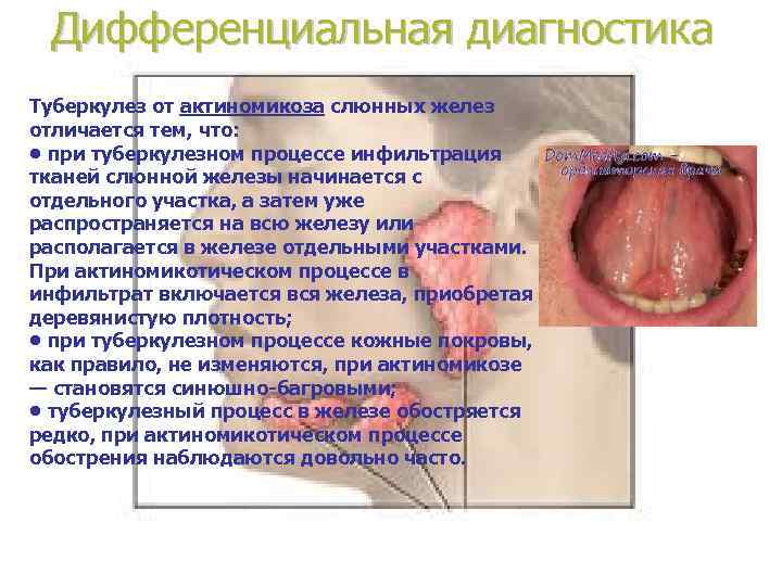  Дифференциальная диагностика Туберкулез от актиномикоза слюнных желез отличается тем, что:  • при