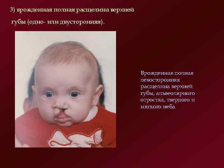 3) врожденная полная расщелина верхней губы (одно или двусторонняя).    Врожденная полная