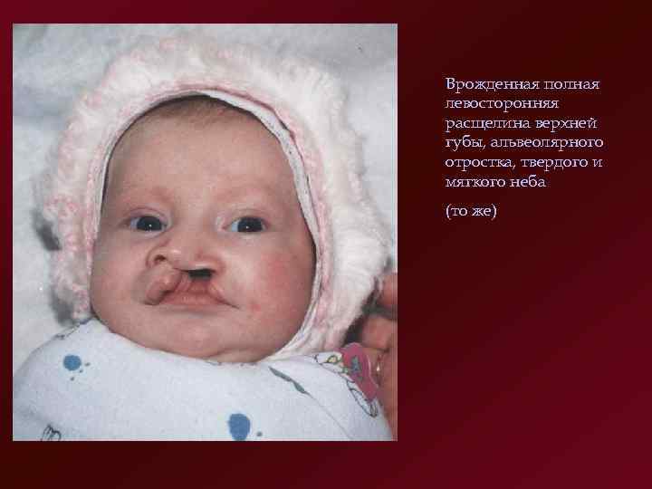 Врожденная полная левосторонняя расщелина верхней губы, альвеолярного отростка, твердого и мягкого неба (то же)