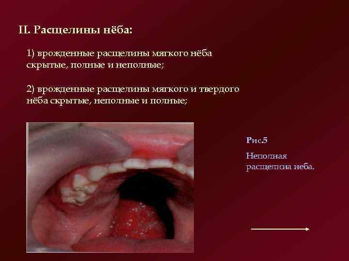 II. Расщелины нёба:  1) врожденные расщелины мягкого нёба скрытые, полные и неполные; 