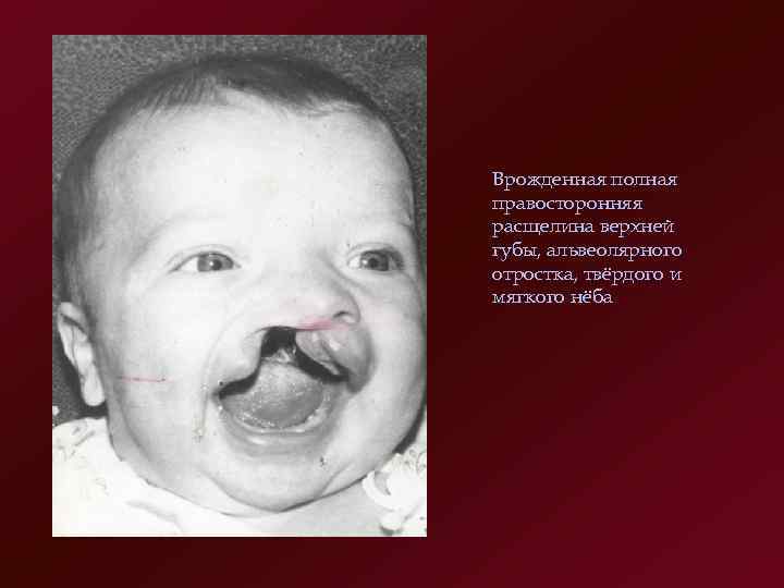 Врожденная полная правосторонняя расщелина верхней губы, альвеолярного отростка, твёрдого и мягкого нёба 