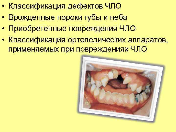  •  Классификация дефектов ЧЛО •  Врожденные пороки губы и неба •