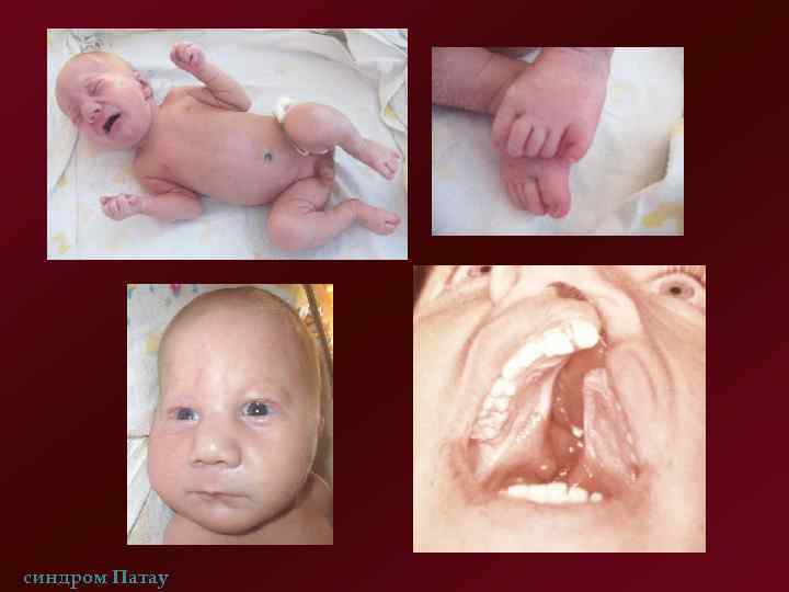 синдром Патау 