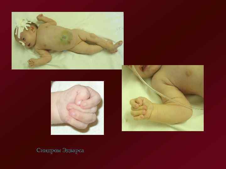 Синдром Эдварса 