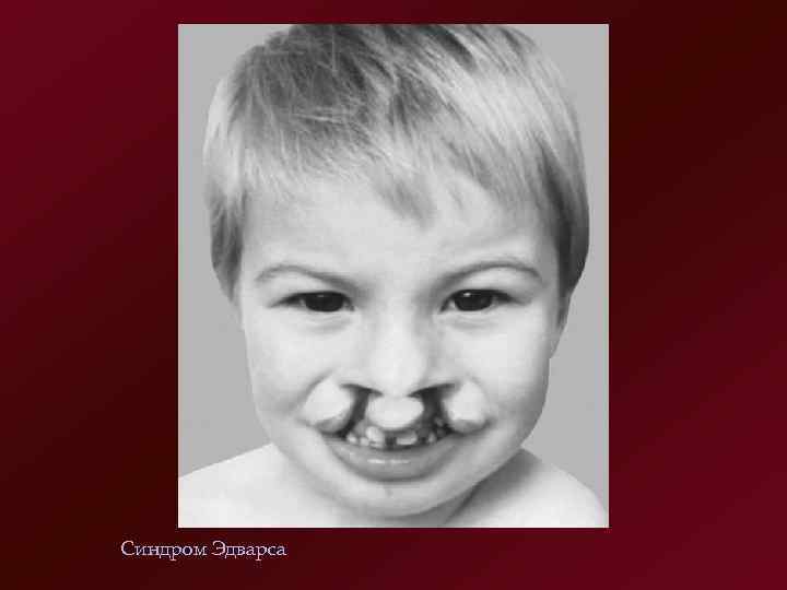 Синдром Эдварса 