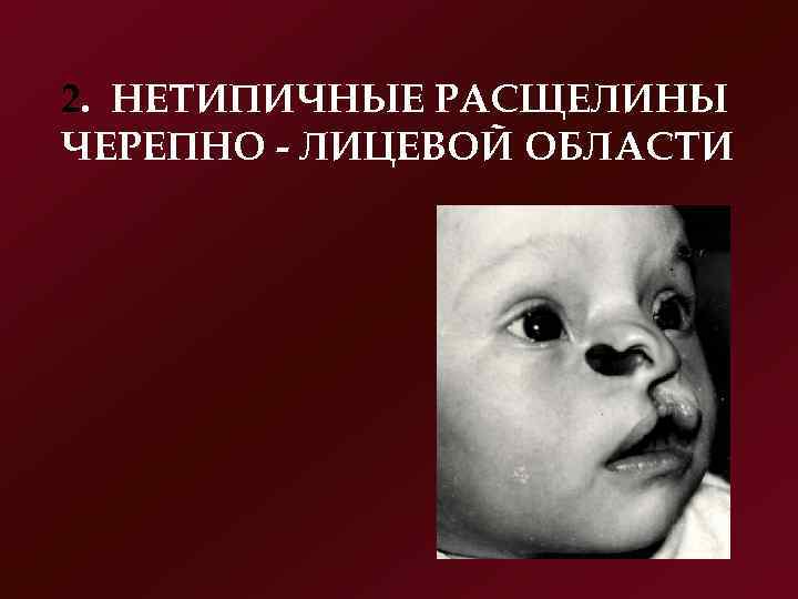 2. НЕТИПИЧНЫЕ РАСЩЕЛИНЫ ЧЕРЕПНО  ЛИЦЕВОЙ ОБЛАСТИ 