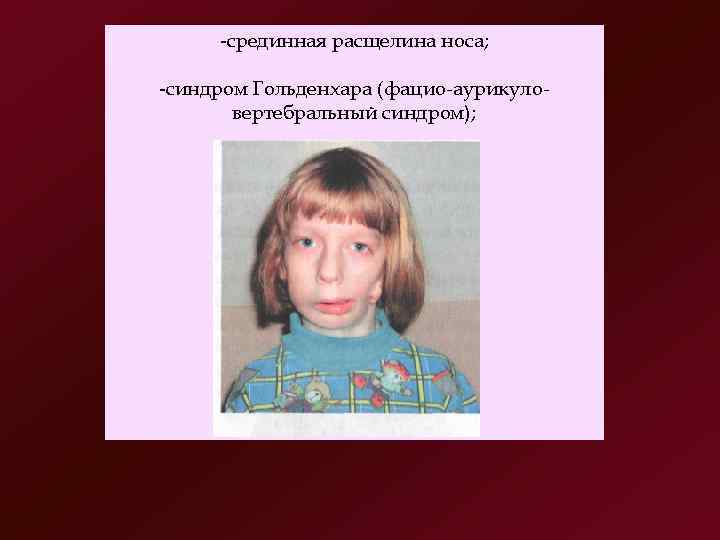  срединная расщелина носа;  синдром Гольденхара (фацио аурикуло   вертебральный синдром); 