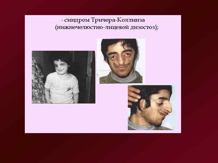   синдром Тричера Коллинза (нижнечелюстно лицевой дизостоз); 