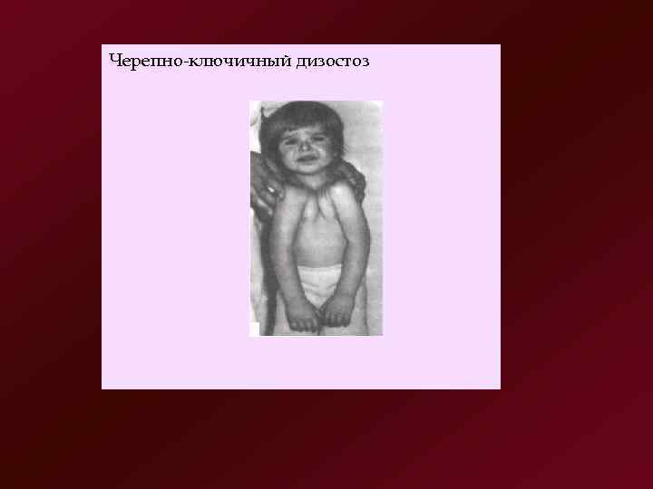 Черепно ключичный дизостоз 