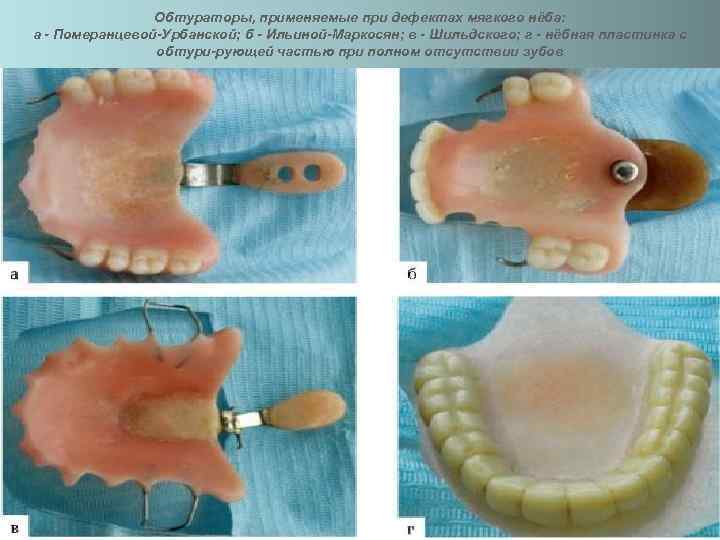     Обтураторы, применяемые при дефектах мягкого нёба: а - Померанцевой-Урбанской; б