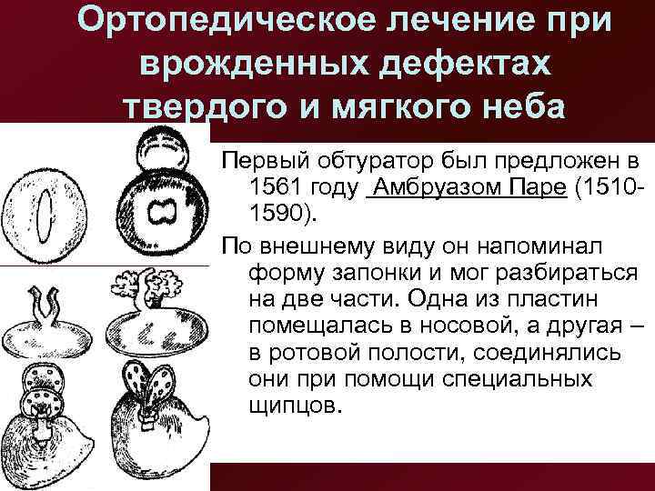 Ортопедическое лечение при врожденных дефектах  твердого и мягкого неба  Первый обтуратор был