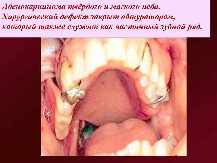 Аденокарцинома твёрдого и мягкого неба.  Хирургический дефект закрыт обтуратором,  который также служит