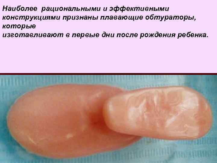 Наиболее рациональными и эффективными конструкциями признаны плавающие обтураторы, которые изготавливают в первые дни после