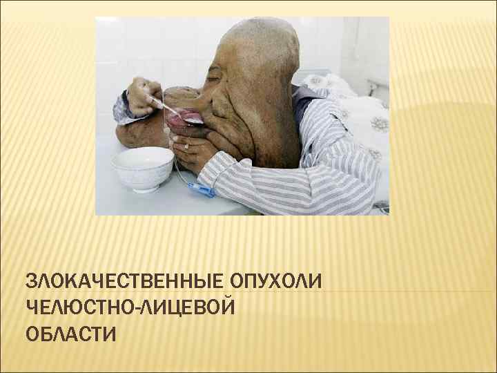 ЗЛОКАЧЕСТВЕННЫЕ ОПУХОЛИ ЧЕЛЮСТНО-ЛИЦЕВОЙ ОБЛАСТИ 