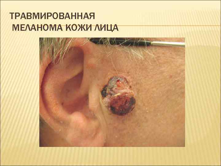 ТРАВМИРОВАННАЯ МЕЛАНОМА КОЖИ ЛИЦА 
