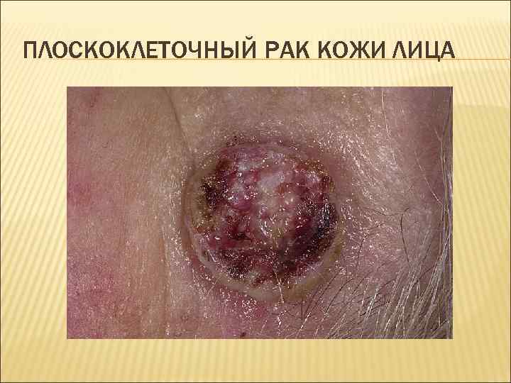 ПЛОСКОКЛЕТОЧНЫЙ РАК КОЖИ ЛИЦА 