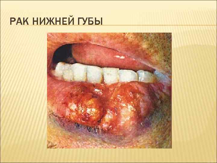 РАК НИЖНЕЙ ГУБЫ 
